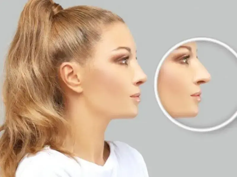 NASENKORREKTUR OHNE OP